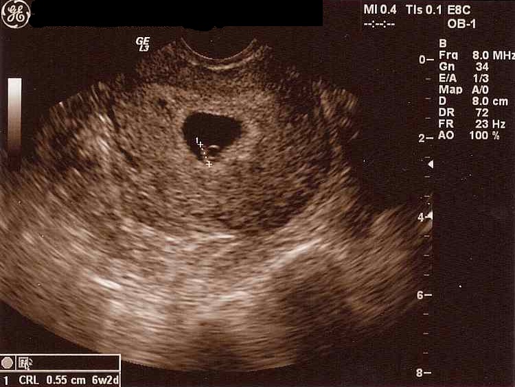 ultrasounds at 6 weeks. 6 weeks